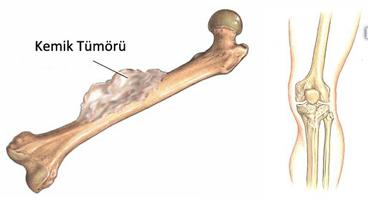 Kemik Kanseri (Osteosarkom) Evreleri: Evre I-A: 8 cm den küçük- düşük dereceli Evre I-B: 8 cm den büyük- düşük dereceli Evre II-A: 8 cm den küçük- yüksek