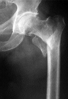 292 Acta Orthop Traumatol Turc gözlendi ini ve medial deplasman osteotomisinin komplikasyon oran n de ifltirmedi ini bildirmifllerdir.