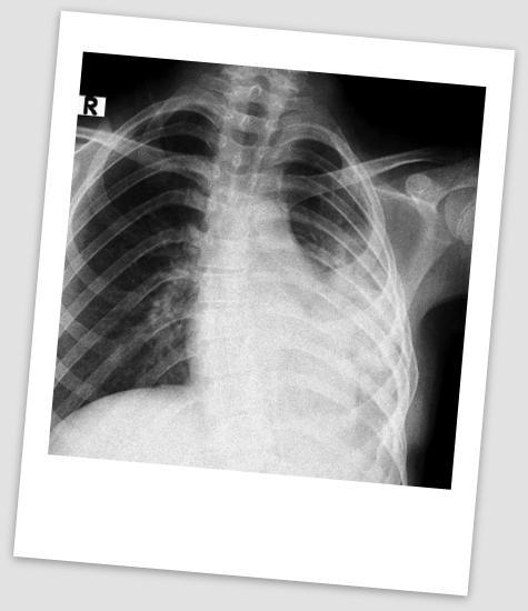 operasyonda göğüs içinde posterio-lateral lokalizasyonda göğüs duvarı yumuşak dokusu ve pariyetal plevradan kaynaklanarak büyümüş, mediastinal plevra, perikard ve diyafragmayı invaze etmiş, aorta ile