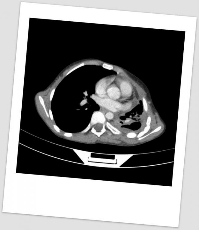 Şekil 2 : Sol da akciğer parankimini baskılayan plevral kalınlaşma Operasyona alınan hastada sol 5. interkostal aralıktan posterio-lateral torakotomi yapıldı.
