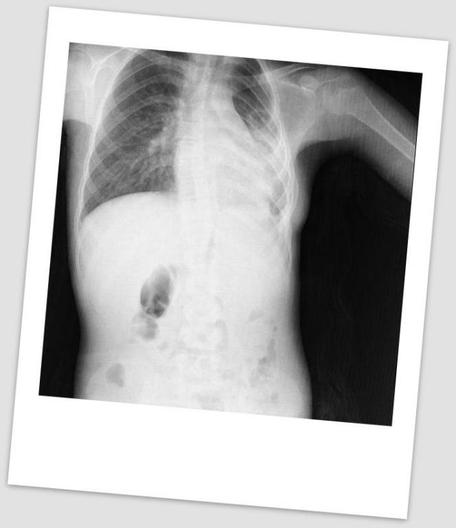 Şekil 3 : Postoperatif akciğer grafisi Patoloji sonucu Ewing sarkomu olarak rapor edilen hasta postoperatif uzak organ yayılımı açısından tarandı ve uzak organ yayılımı tespit edilmedi.