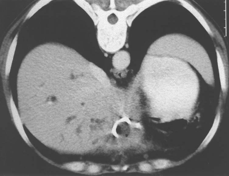 Üç hastaya cerrahi uygulanmasının nedenleri şöyleydi: bir hastada PD sonrası etkin drenaj olmasına ve karaciğerdeki multiple mikro-apseler görüntüleme yöntemleri ile gösterilmiş olmasına rağmen