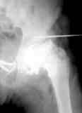(c) Greft çift kat yerlefltirilip kortikal vida tespitinden sonra çekilen ve mentefleli abduksiyonun çat içinde kald n gösteren radyografisi. ayr larak ask ya al nd.