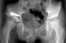 Muratl ve ark. Legg-Calve-Perthes hastal nda asetabuler çat ameliyat sonuçlar m z 141 Merkez kenar aç s ameliyat öncesi radyografilerde 16.