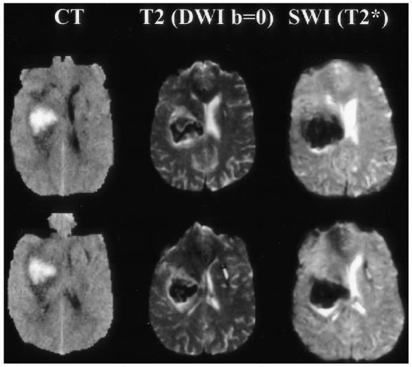 İnflamasyon ve apoptoz sonucu nöronal ve glial hücre