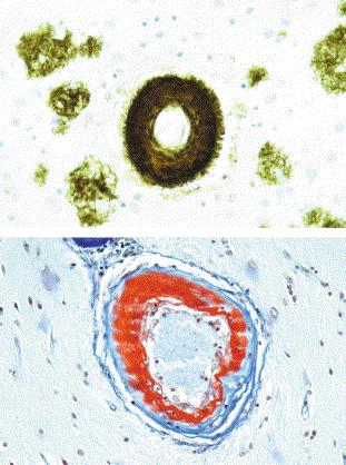 Serebral Amiloid Anjiopati ve İSH Serebral korteks ve leptomeninkslerde küçük ve orta çaplı arterlerde -amiloid birikimi