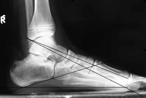 [4,6] Ayak izinin alınması ile yapılan ölçümler basit, ucuz ve kolay uygulanabilir olmasına rağmen, bazı yazarlar statik ölçüme dayanan bu yöntemin ayağın MLA sını tam olarak yansıtmadığını, hatalı