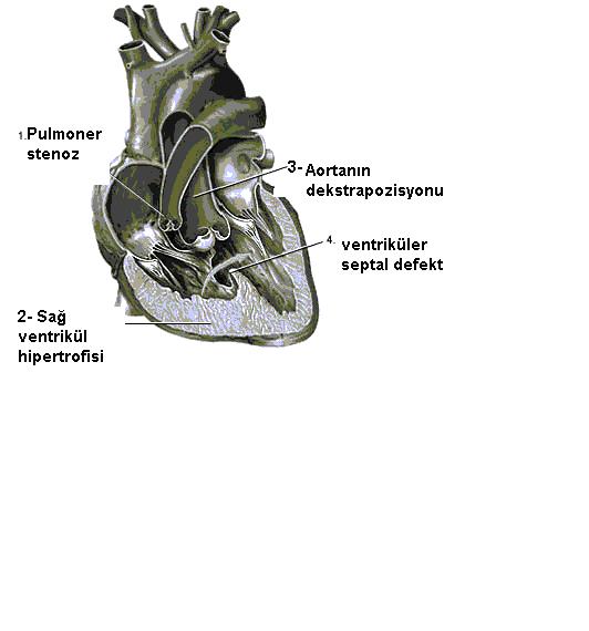 Siyanotik Konjenital Kalp Hastalıkları 1 FALLOT TETRALOJİSİ Etiene-louis Arthur Fallot tarafından 1888 tarihinde tarif edilen bu konjenital kalp hastalığı dört ana patolojiden oluşmaktadır.