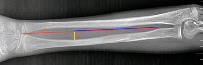 Pediatrik önkol kırıklarının intramedüller elastik çivi ile tedavisi Resim 2: Radial eğim lokasyonu ve radial eğim indeksinin belirlenmesi: Radiusun distal ulnar kenarı ile bisipital tüberkül