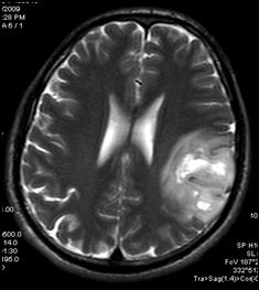 Diffusion-weighted MRI,