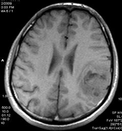 Perfusion MRI MR