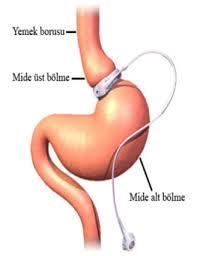 SAYFA NO 2/9 Sleeve Gastrektomi: Tüp mide veya muz mide ameliyatı olarak da bilinmektedir.
