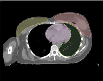 OAR To evaluate the effect of inverse and field in field IMRT plannings on left anterior descenden coroner artery (LAD) doses for left breast cancer Kara E, Akmansu M. Ve ark 10.