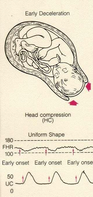 Erken Deselerasyon Mekanizma Kontraksiyon Fetal Baş Kompresyonu Kafa içi