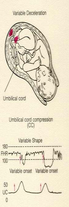 Variable Deselerasyon Mekanizma Umblikal kord kompresyonu Önce umblikal venöz akım durur Fetal