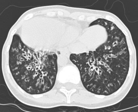 Hastalığın yaygınlığının değerlendirilmesinde kullanılan Toraks BT de en sık akciğer orta lob, lingula ve alt lobun tutulumu hastalığın KF ten ayrılan