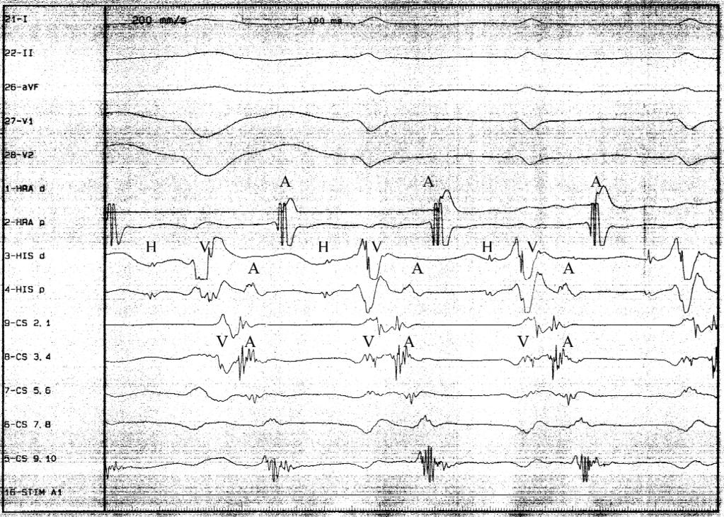 Bunu takip eden üçüncü QRS kompleksi normal olup AV nod üzerinden iletiyi yansıtmaktadır. H: His, A: Atriyal aktivite, V: Ventriküler aktivite B.