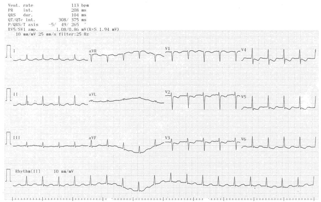 94 Türk Aritmi, Pacemaker ve Elektrofizyoloji Dergisi Giriş Kırk üç yaşında kadın hasta son 6 aydır olan çarpıntı yakınması ile kliniğimize başvurdu.