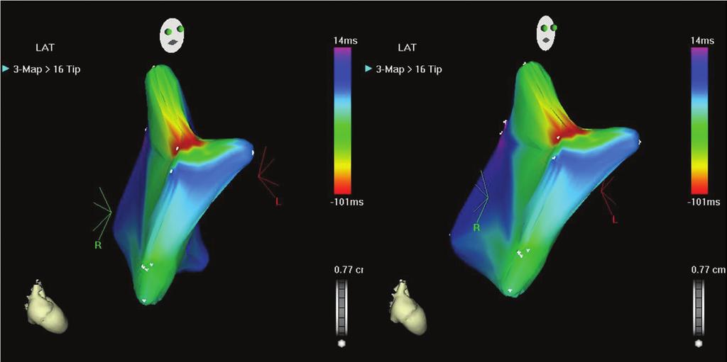 96 Türk Aritmi, Pacemaker ve Elektrofizyoloji Dergisi ŞEKİL 3 Sağ atriyal taşikardinin elektroanatomik haritalaması gösterilmektedir ŞEKİL 4 Elektroanatomik haritalama sonrası uygulanan ablasyon