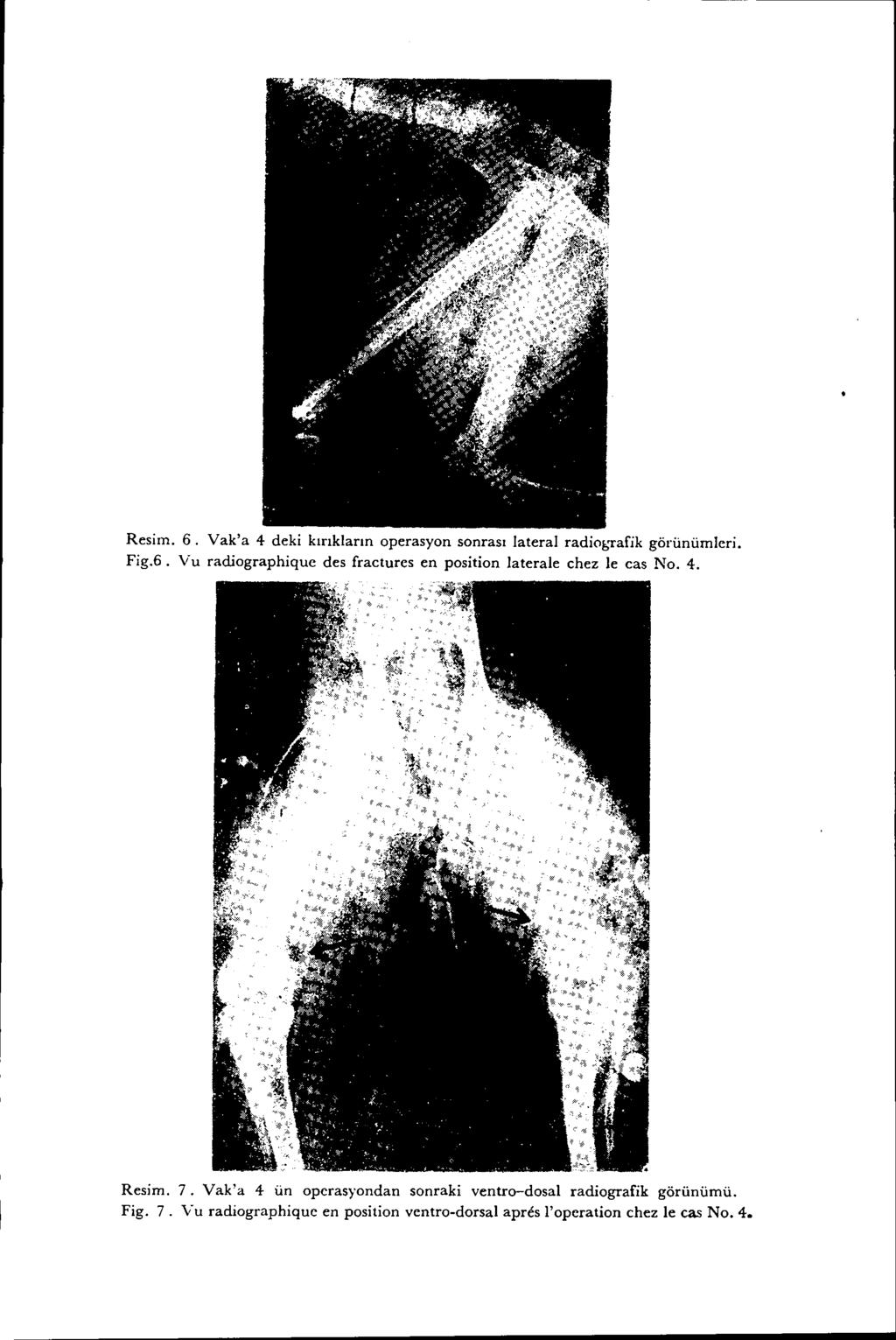 Resim. 6. Yak'a 4 deki kırıkların operasyon sonrası lateral radio~;rafik görünümleri. Fig.6. Vu radiographique des fraetures en position laterale ehez le eas No. 4. Resim.