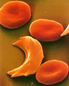 Normal hemoglobin taşıyan normal eritrositler esnektir, kan akışıyla küçük kılcal damarlardan rahatça geçebilir.