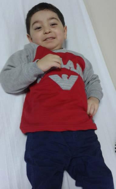 OLGU-2 4 yaş, erkek Şikayet/Hikaye West sendromu, hipotoni ve serebellar atrofi nedeni ile