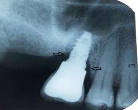 Resim 2. İmplant çevresi kemik kaybını gösteren radyografi TARTIŞMA Peri-implantitis, osseointegre implantların başarısının değerlendirilmesinde kullanılan geleneksel bir kriterdir.