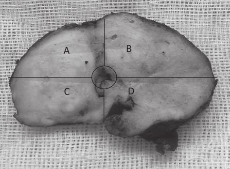 Resim 1. Prostattan alınan bir dilim. A ve B anterior, C ve D posterior kadranlar olarak gözlenmektedir.