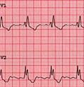 Normal 4) QRS