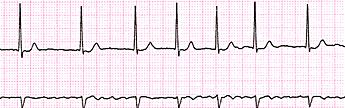 Atrial