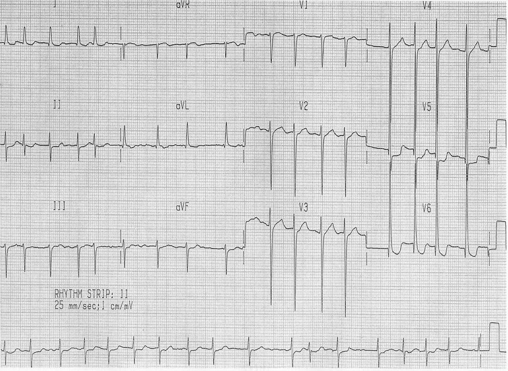 Atrial