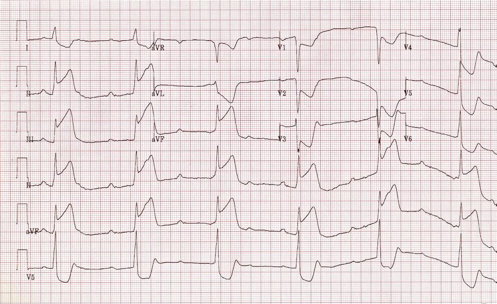 Akut inferior MI, A-V tam blok Kaynak