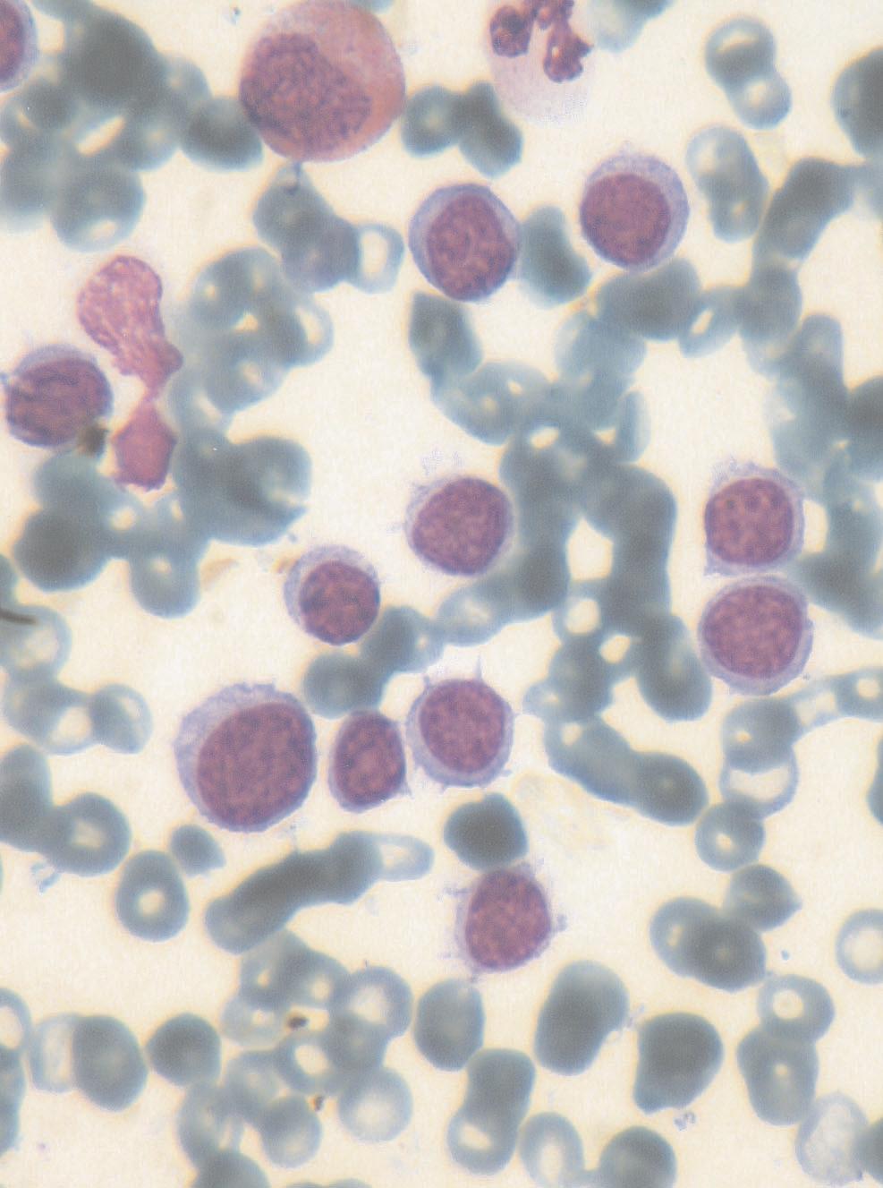 Resim 1. Kemik iliği aspirasyonu: Santral nükleuslu, belirgin stoplazmik projeksiyonlu lenfoid hücreler (Giemsa X100). kliniko-patolojik antite olarak değerlendirilmiştir (6).