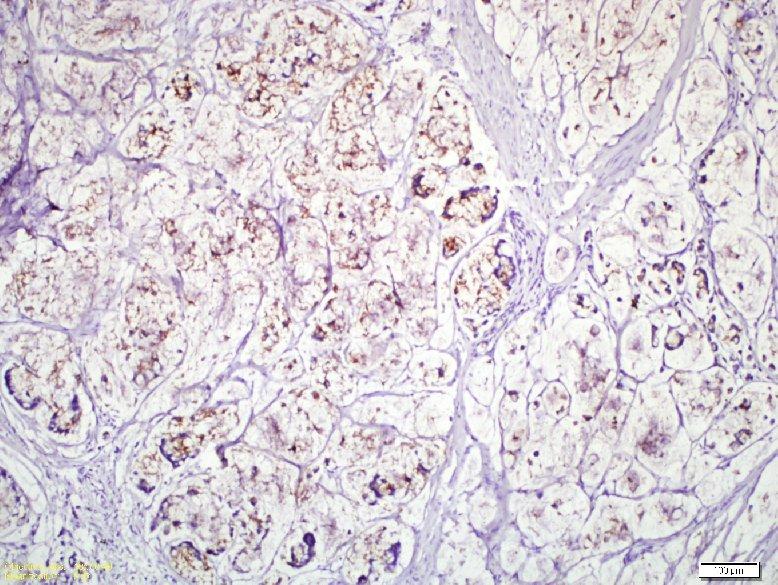 a) Müsinöz karsinom vakasında sitoplazmik pozitif tümör hücreleri.