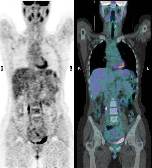 A B Resim 2: 44 yaşında bayan hasta, sağ memeden İİAB sonucu meme kanseri tanısı konmuş olup A: Tüm vücut PET görüntüsü B: Tüm vücut PET/BT füzyon görüntüsünde sağ aksillada SUVmax: 2.