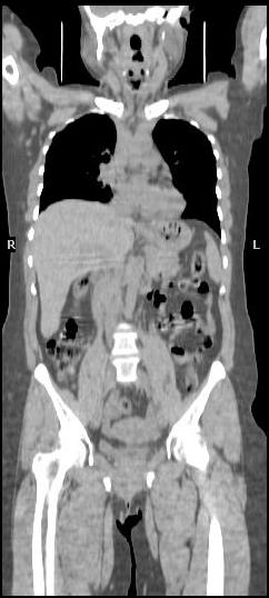 A B C Resim 3: 39 yaşında bayan hasta, sağ memede kitle nedeniyle yapılan trucut biopsi sonucu meme kanseri