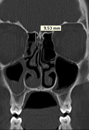 1 Hastaların gerek preoperatif gerekse intraopeatif olarak olfaktor fossa ve lateral lamella uzunluğunun değerlendirilmesi daha önce de bahsedildiği gibi major komplikasyonlardan koruyucu etki sağlar.