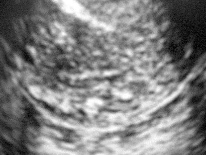 Postmenopozal uterus kanamalar önerilen endometrial küretajd r (11).