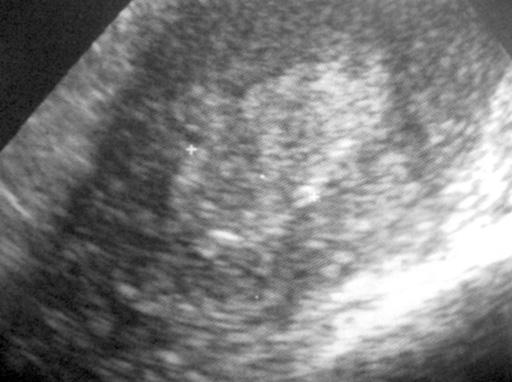 Postmenopozal kanamalara günümüz yaklafl m transvajinal ultrasonografi, transvajinal sonohisterografi, histeroskopi ve endometriyal biyopsi kombinasyonunu uygulamakt r (15, 20,26,32).