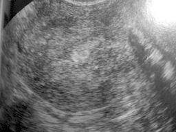 Postmenopozal uterus kanamalar Resim 5-6. Endometriyal polipin solda transvajinal ultrasonografi, sa da sonohisterografi sonras görüntüsü. Resim 7. Endometriyum karsinomunun histeroskopik görüntüsü.