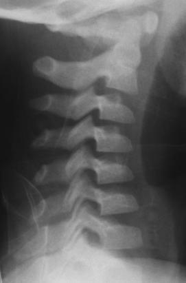 demek SCI yaralanması olmadığı anlamına gelmez MRI iyi bir