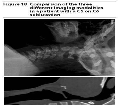 ve ligamentoz instabilite bulguları olmamasına rağmen myelopati