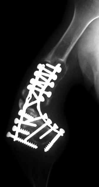 Her vida karşı taraf vidalarla kenetlenerek tüm distal humerusa stabilite sağlayacak şekilde bir mimari oluşturmalıdır. 7. Plak her iki kolonda kompresyon oluşturacak şekilde uygulanmalıdır. 8.