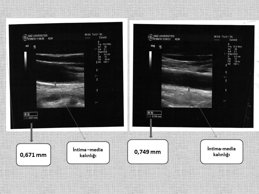 2.8.1 Karotis Arter İntima-Media Kalınlığının Saptanması Aterosklerotik plak sonografik olarak, ilk önce intima ve media tabakalarının kombine kalınlığında artış ve daha sonra arteriyel lümene uzanan