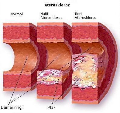2.8.2. Plak Patogenezi Günümüzdeki geçerli teori aterosklerozun, arterleri döşeyen endotelyal hücrelerin rol aldığı hasara bir cevap olduğu temeline dayanır.