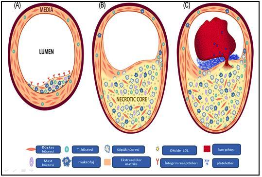 Şekil 14: Aterosklerotik Plak Oluşumunda Etkili Hücreler Daha önce belirtilen dejeneratif değişiklikler arasında en önemlileri, plak içeriğinin kan akımına dökülmesine ve direkt olarak embolizasyona