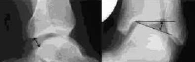 14 Acta Orthop Traumatol Turc Suppl proksimale migrasyonu veya k r peroneus longus rüptürünü gösterir.