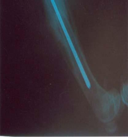 Radiographic M/L view of pin migration on postoperative 8th day of Case No: 7. Şekil 6.