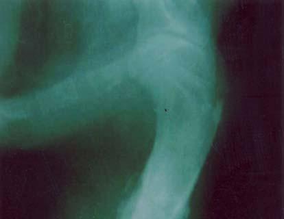 günde gözlenen taşkın kallus dokusunun M/L radyografik görünümü. Figure 5.