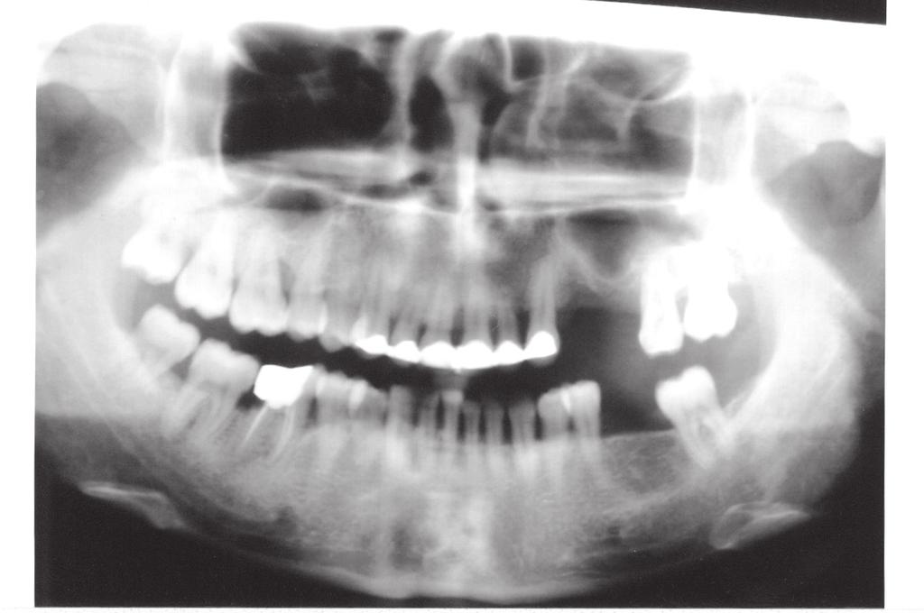 12 Gİrİş Maksiller posterior bölgede özellikle erken dönem diş kayıpları sonrasında maksiller sinüsün alveoler krete doğru sarkması nedeniyle ilgili bölgede dental implant tedavisi düşünülüyorsa